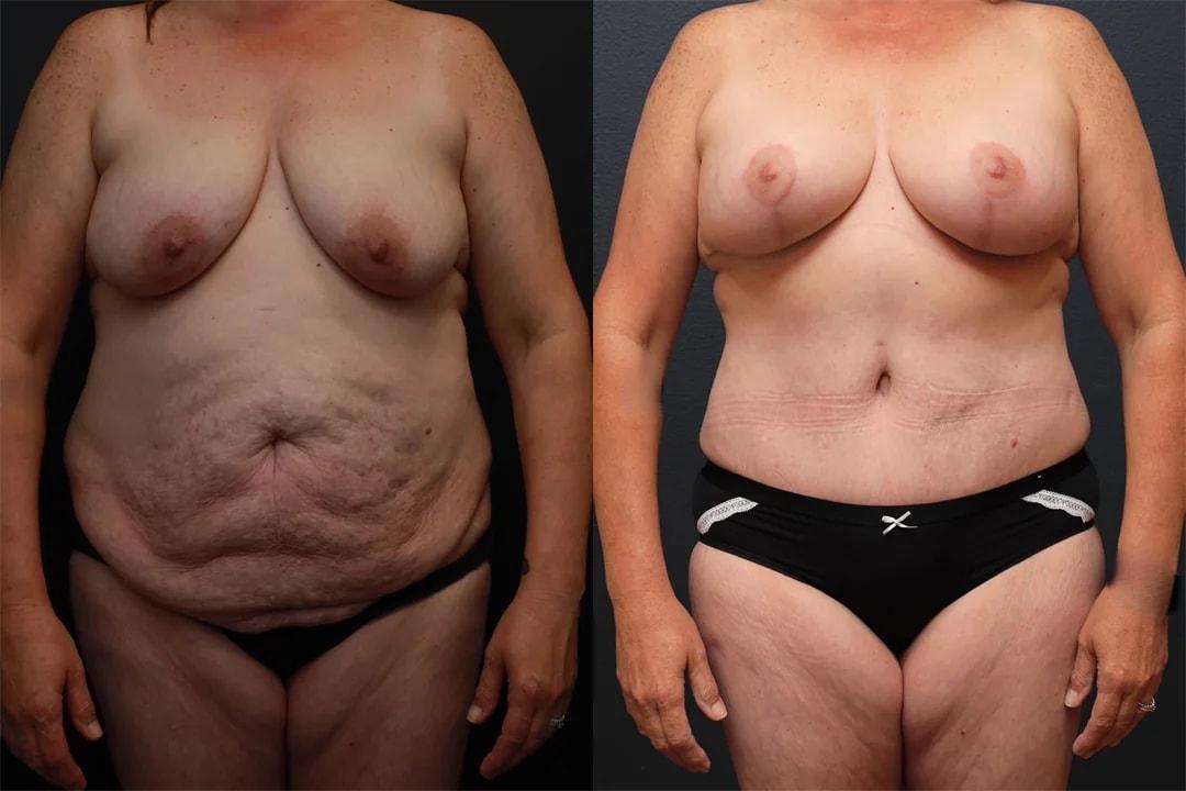 Motakef Plastic Surgery + Med Spa mommy makeover result — Yorba Linda, CA
