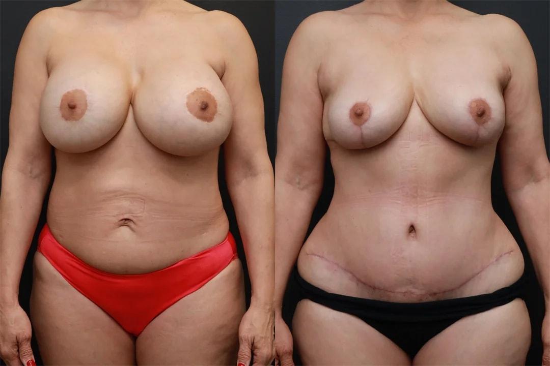Motakef Plastic Surgery + Med Spa mommy makeover result — Yorba Linda, CA
