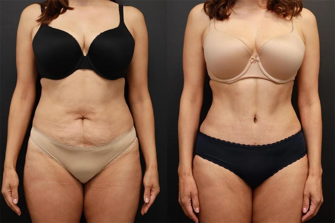 Motakef Plastic Surgery + Med Spa tummy tuck result — Yorba Linda, CA