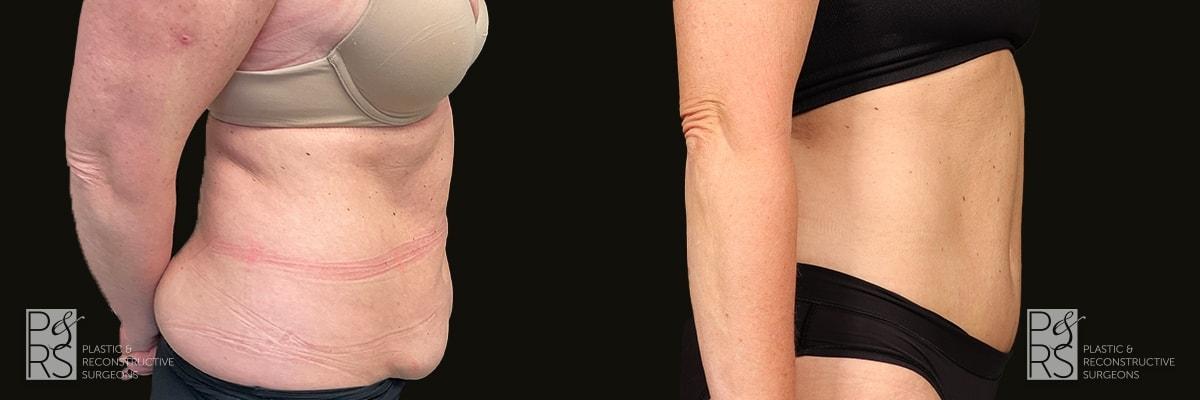Jonathan Hutter, MD tummy tuck result — Maple Valley, WA