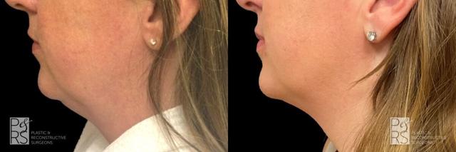 Neck Liposuction result at Jonathan Hutter, MD in Maple Valley, WA