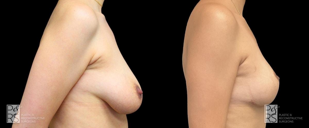 Jonathan Hutter, MD breast lift result — Maple Valley, WA
