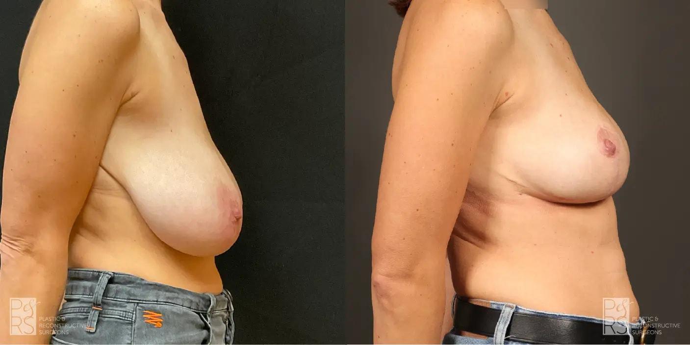 Jonathan Hutter, MD breast lift result — Maple Valley, WA