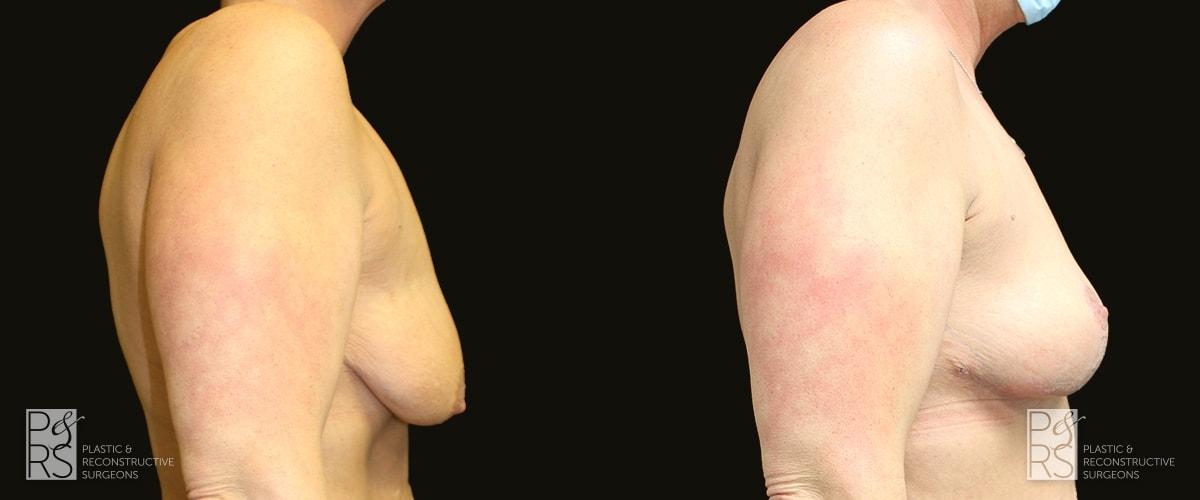 Jonathan Hutter, MD breast lift result — Maple Valley, WA