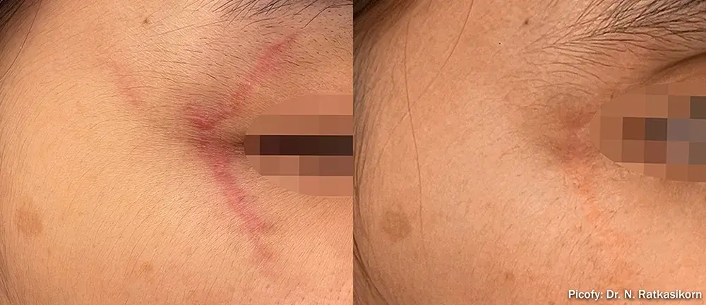 The Luxe Medspa Aesthetics & Bodycare laser treatment result — Upper Arlington, OH