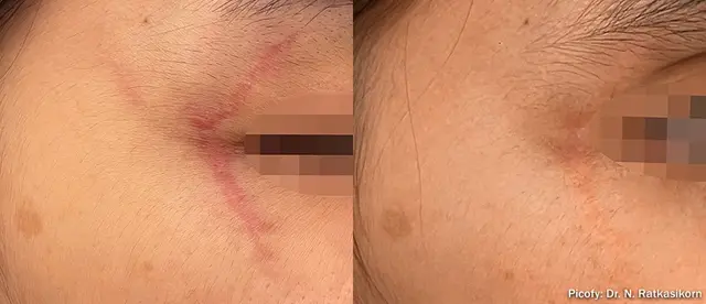 Laser Skin Resurfacing result at The Luxe Medspa Aesthetics & Bodycare in Upper Arlington, OH