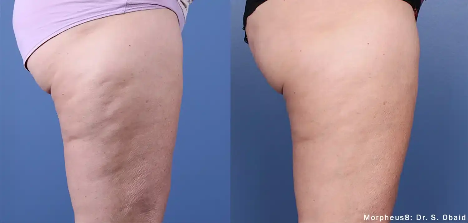 The Luxe Medspa Aesthetics & Bodycare skin tightening result — Upper Arlington, OH
