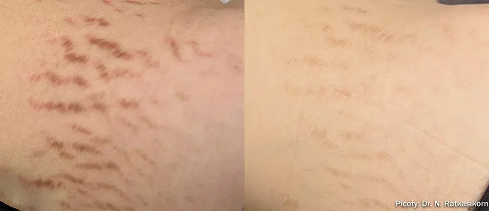 The Luxe Medspa Aesthetics & Bodycare laser treatment result — Upper Arlington, OH