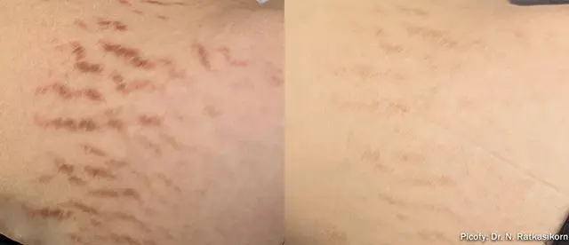 Laser Skin Resurfacing result at The Luxe Medspa Aesthetics & Bodycare in Upper Arlington, OH