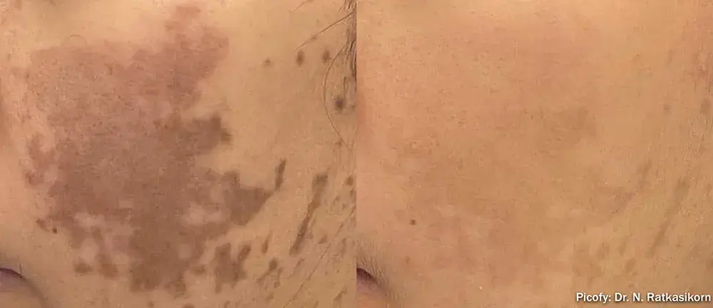 The Luxe Medspa Aesthetics & Bodycare laser treatment result — Upper Arlington, OH
