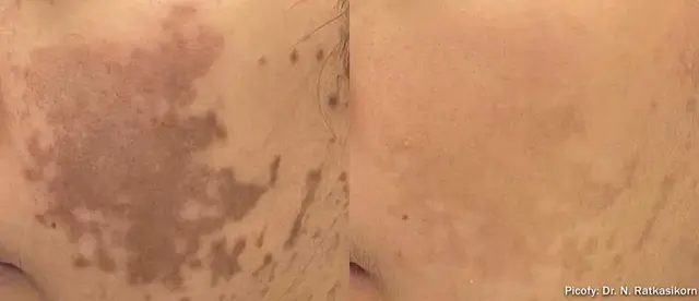 Laser Skin Resurfacing result at The Luxe Medspa Aesthetics & Bodycare in Upper Arlington, OH