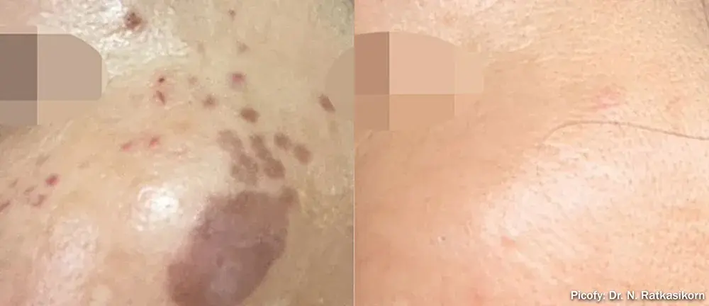 The Luxe Medspa Aesthetics & Bodycare laser treatment result — Upper Arlington, OH