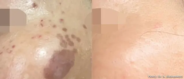 Laser Skin Resurfacing result at The Luxe Medspa Aesthetics & Bodycare in Upper Arlington, OH