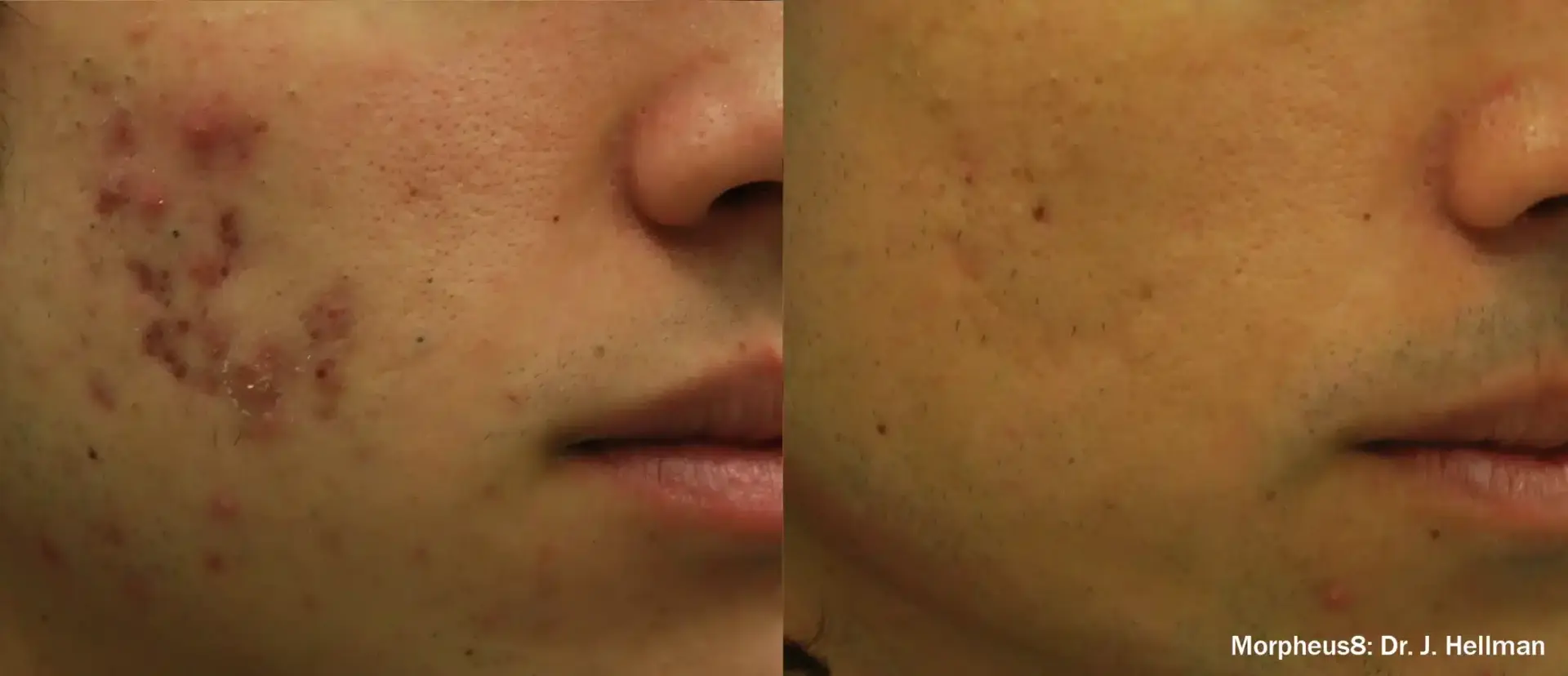 The Luxe Medspa Aesthetics & Bodycare skin tightening result — Upper Arlington, OH
