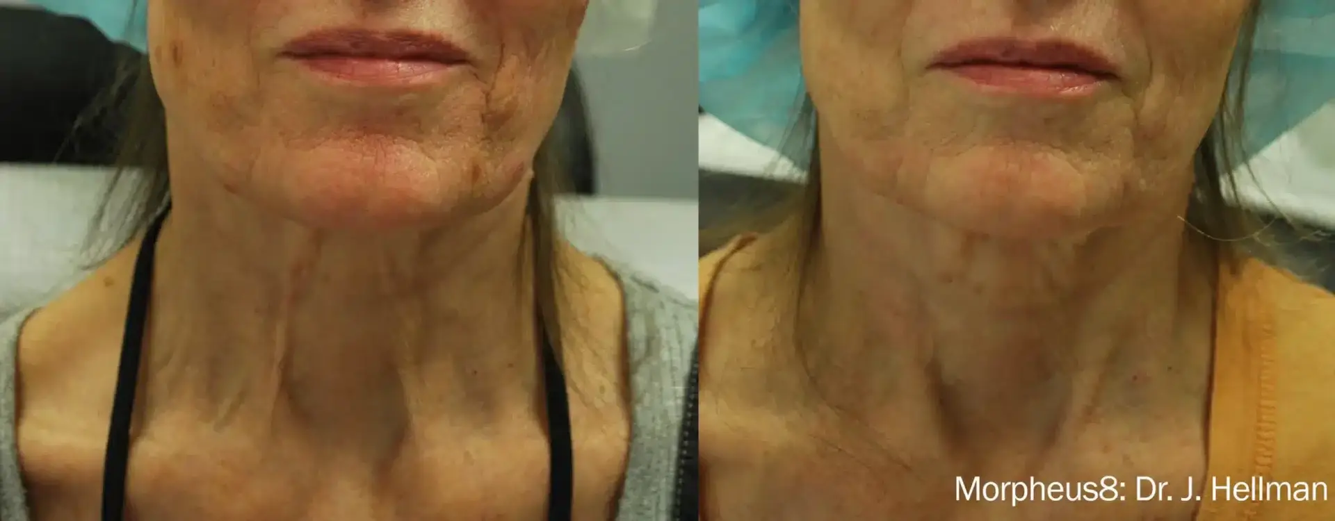 The Luxe Medspa Aesthetics & Bodycare skin tightening result — Upper Arlington, OH