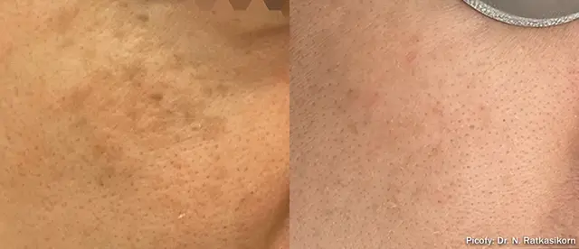 Laser Skin Resurfacing result at The Luxe Medspa Aesthetics & Bodycare in Upper Arlington, OH