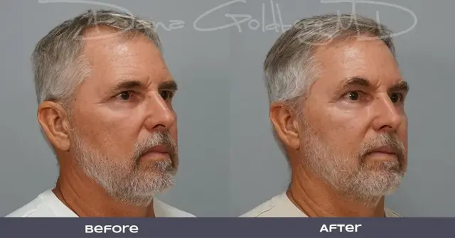 Brow Lift result at Dana M. Goldberg, MD in Jupiter, FL