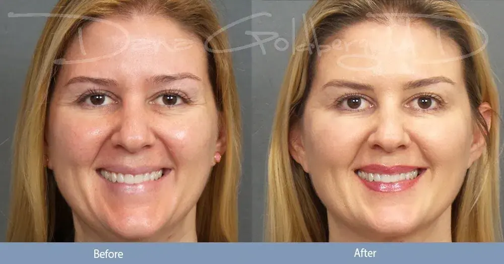 Dana M. Goldberg, MD photofacial result — Jupiter, FL