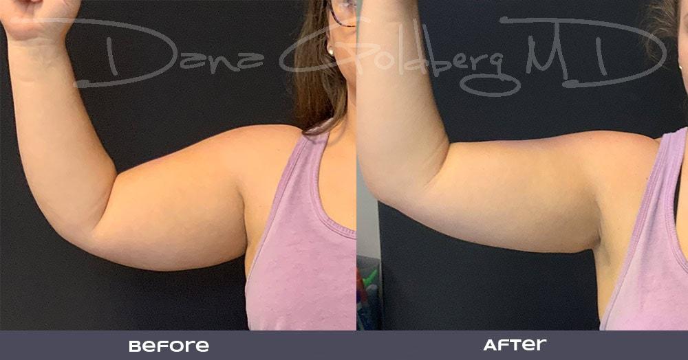 Dana M. Goldberg, MD coolsculpting result — Jupiter, FL