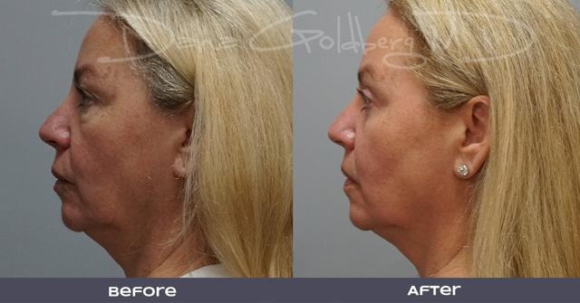 Laser Skin Resurfacing result at Dana M. Goldberg, MD in Jupiter, FL