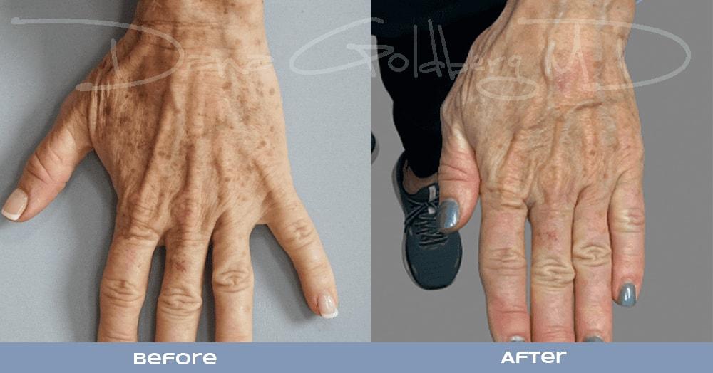 Dana M. Goldberg, MD photofacial result — Jupiter, FL