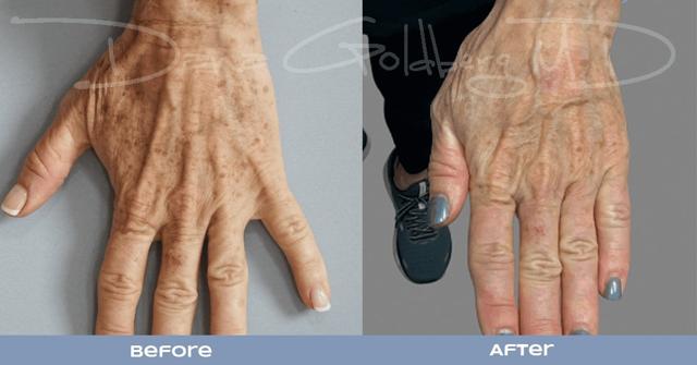 Microneedling result at Dana M. Goldberg, MD in Jupiter, FL