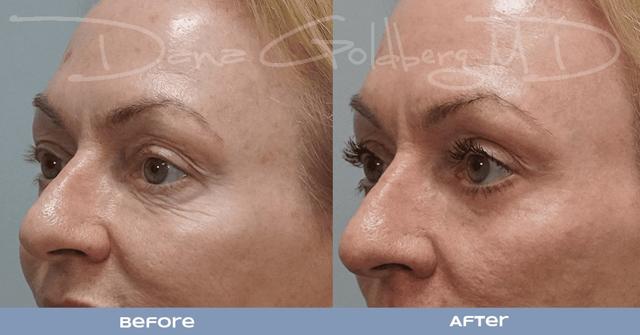 Laser Skin Resurfacing result at Dana M. Goldberg, MD in Jupiter, FL
