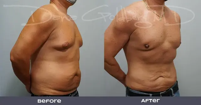Liposuction result at Dana M. Goldberg, MD in Jupiter, FL