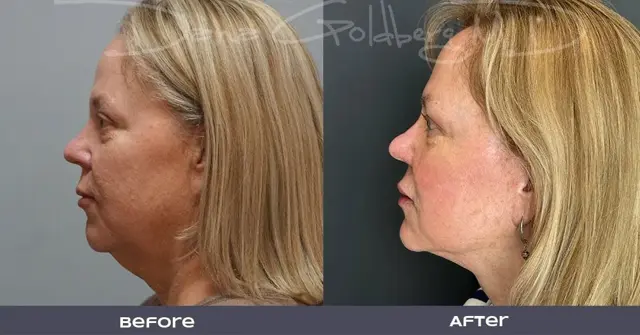 Deep Plane Facelift result at Dana M. Goldberg, MD in Jupiter, FL