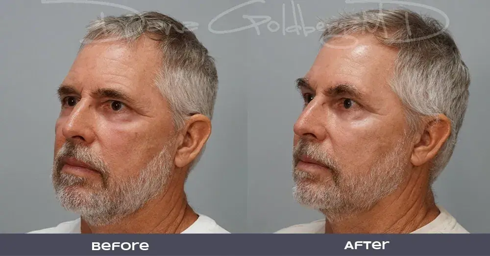 Dana M. Goldberg, MD brow lift result — Jupiter, FL