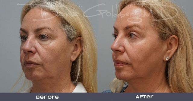 Laser Skin Resurfacing result at Dana M. Goldberg, MD in Jupiter, FL