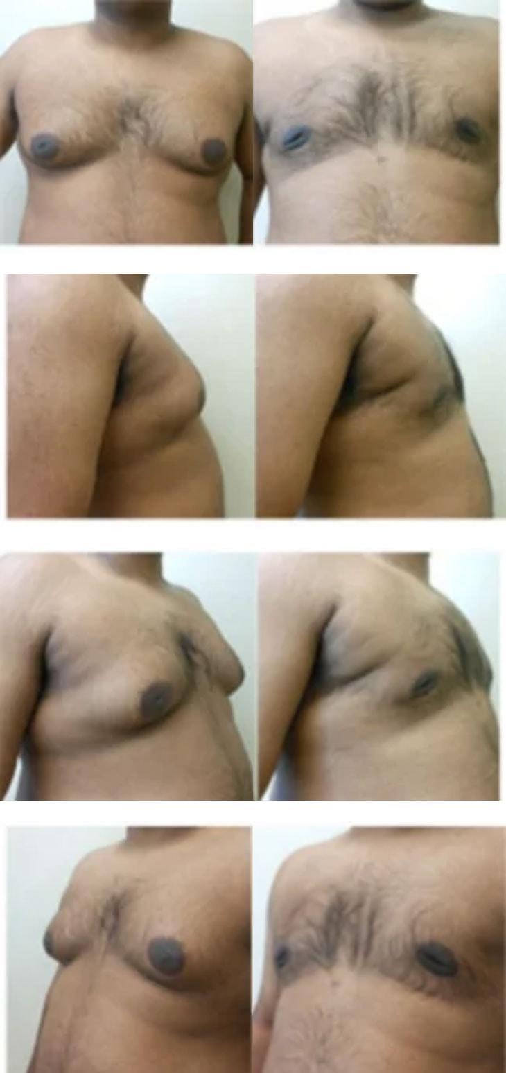 Atlantic Center for Plastic & Cosmetic Surgery gynecomastia result — Duluth, GA