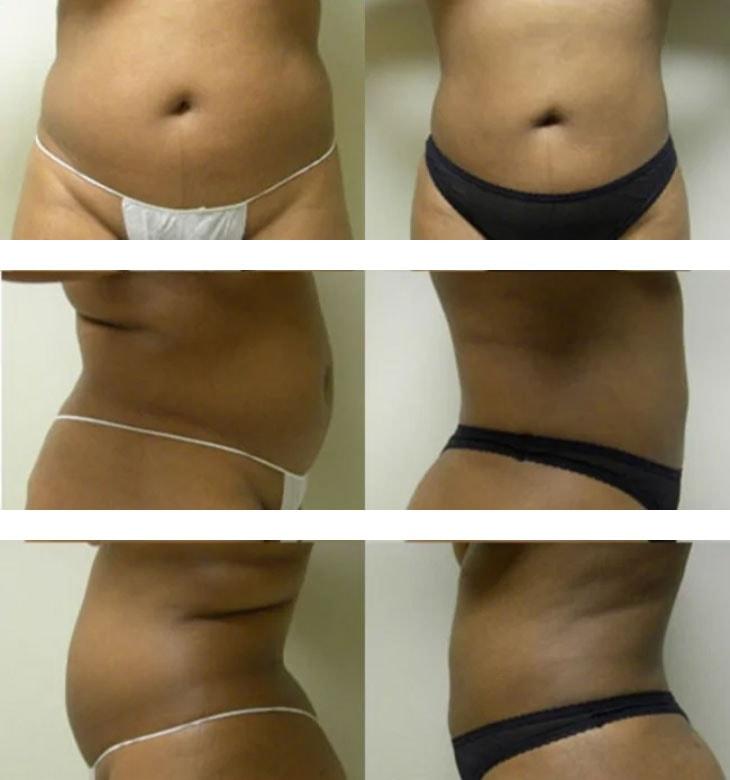 Atlantic Center for Plastic & Cosmetic Surgery tummy tuck result — Duluth, GA