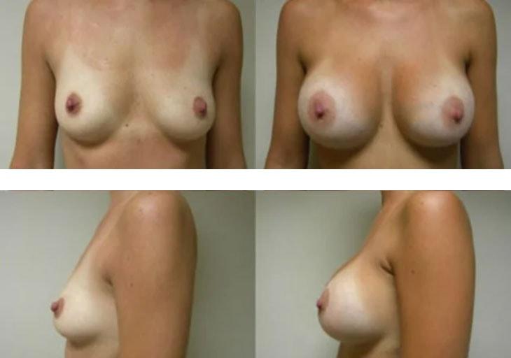 Atlantic Center for Plastic & Cosmetic Surgery breast augmentation result — Duluth, GA
