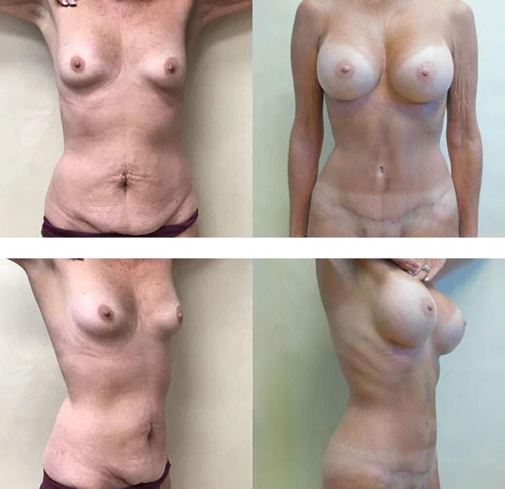 Atlantic Center for Plastic & Cosmetic Surgery breast augmentation result — Duluth, GA