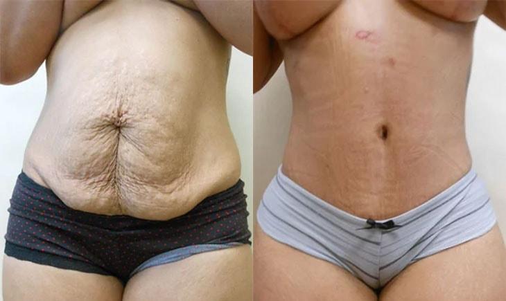 Atlantic Center for Plastic & Cosmetic Surgery tummy tuck result — Duluth, GA