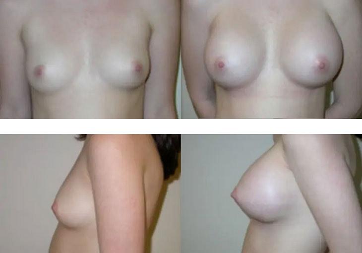 Atlantic Center for Plastic & Cosmetic Surgery breast augmentation result — Duluth, GA