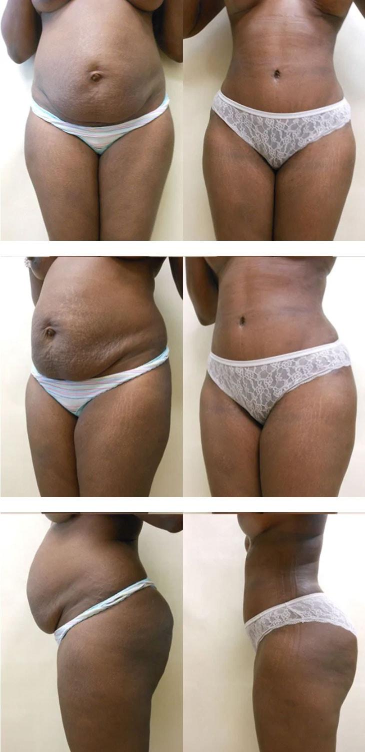 Atlantic Center for Plastic & Cosmetic Surgery tummy tuck result — Duluth, GA
