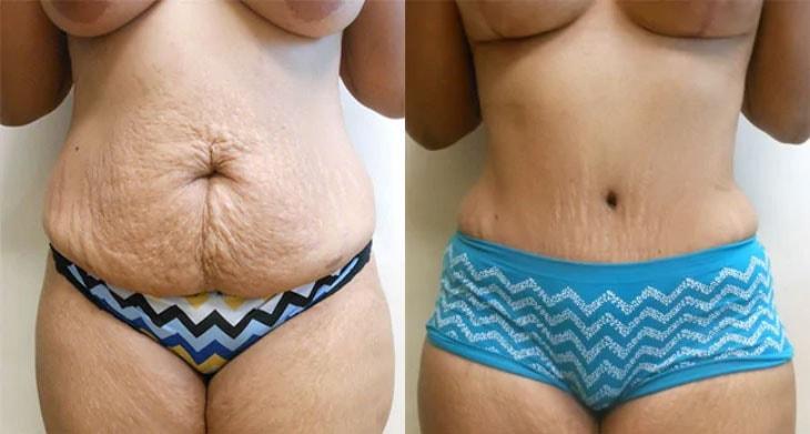Atlantic Center for Plastic & Cosmetic Surgery tummy tuck result — Duluth, GA