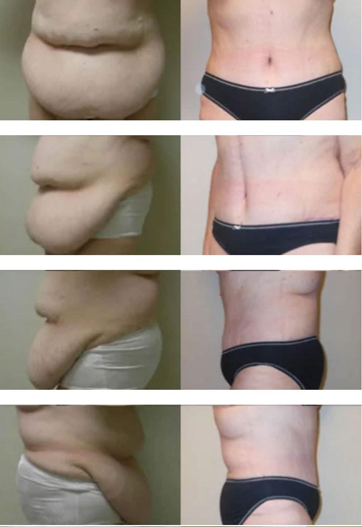 Atlantic Center for Plastic & Cosmetic Surgery tummy tuck result — Duluth, GA