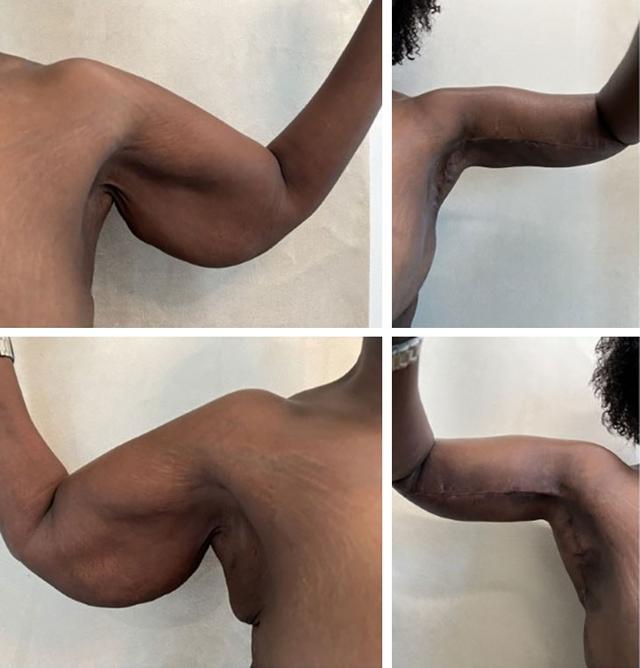 Arm Lift result at Atlantic Center for Plastic & Cosmetic Surgery in Duluth, GA