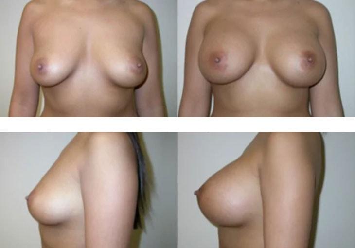 Atlantic Center for Plastic & Cosmetic Surgery breast augmentation result — Duluth, GA