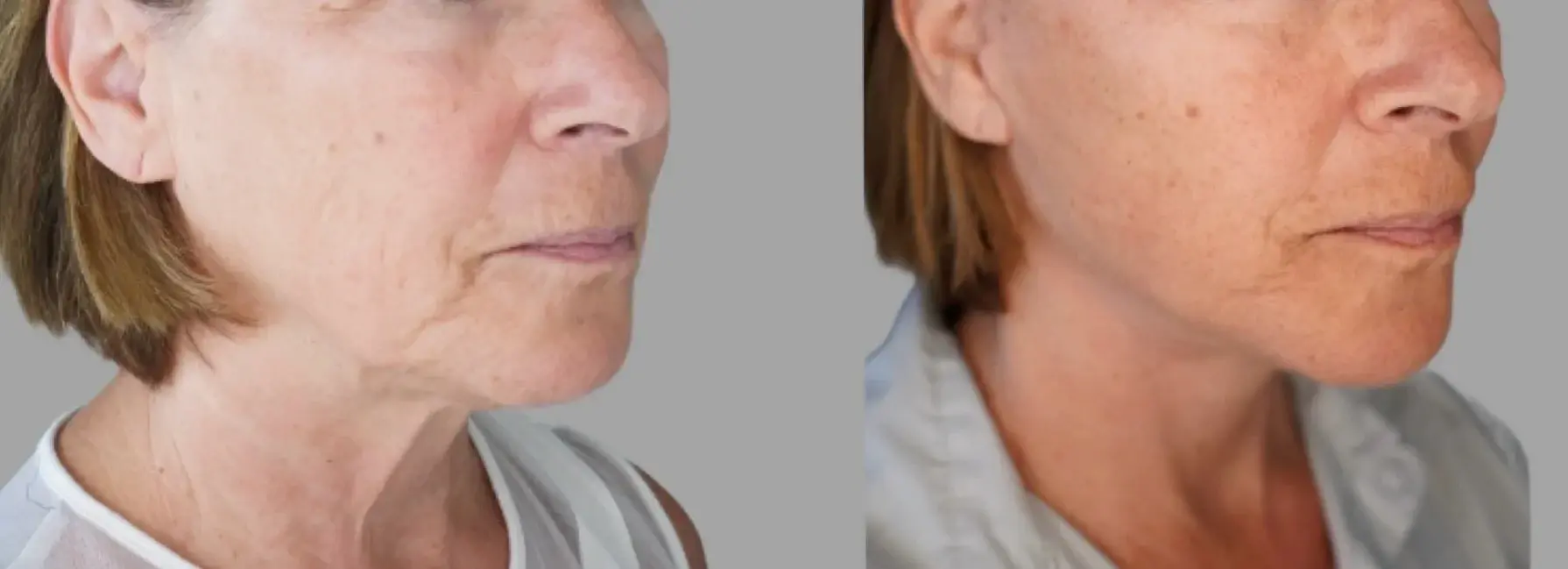 Pavlo Isak, MD facelift result — Newport Beach, CA