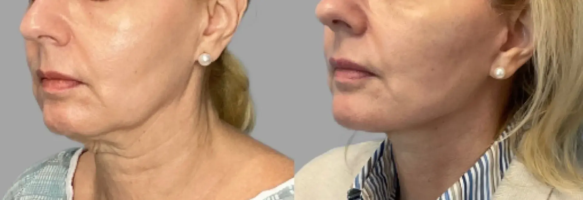 Pavlo Isak, MD facelift result — Newport Beach, CA