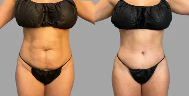 Tummy Tuck result at Pavlo Isak, MD in Newport Beach, CA