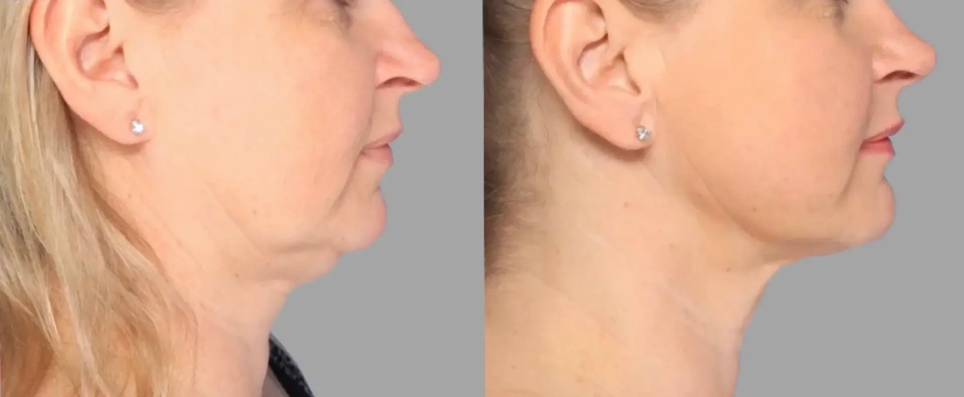 Pavlo Isak, MD submental liposuction result — Newport Beach, CA