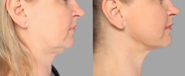 Neck Liposuction result at Pavlo Isak, MD in Newport Beach, CA