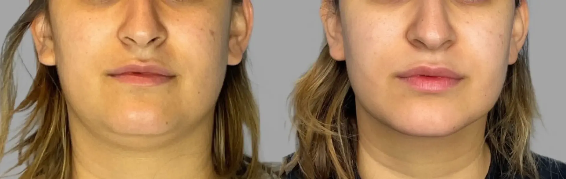 Pavlo Isak, MD submental liposuction result — Newport Beach, CA