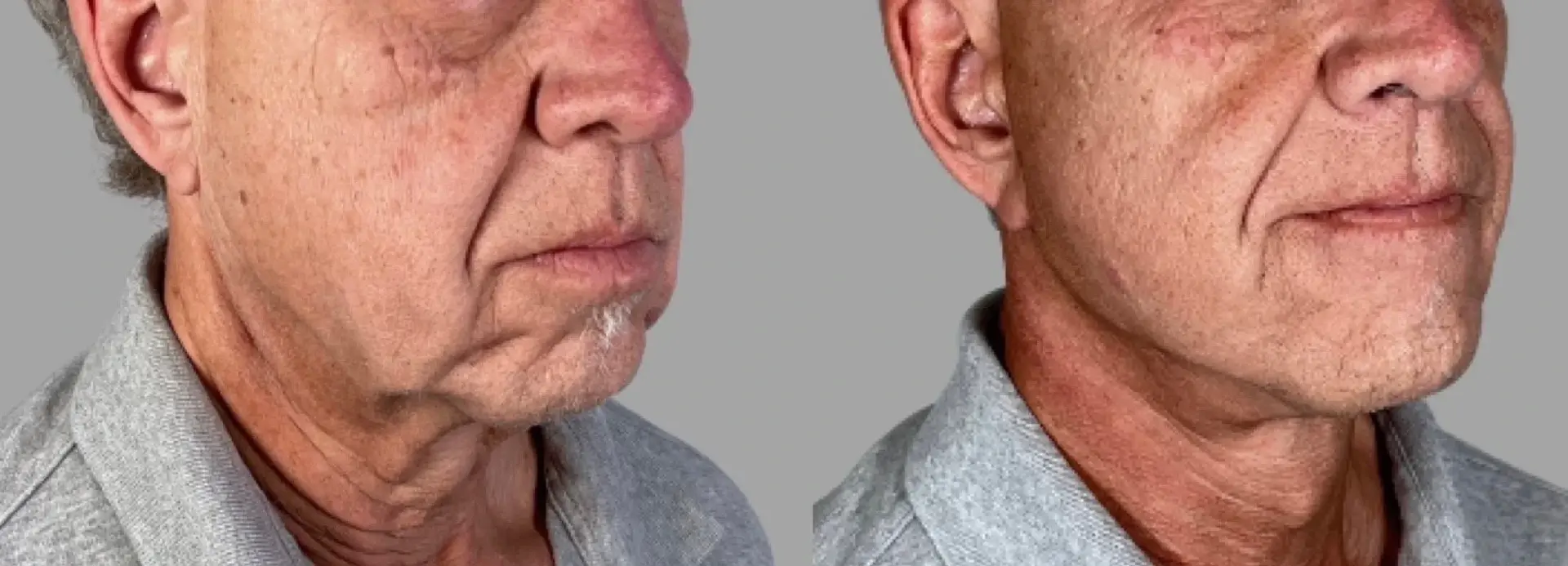 Pavlo Isak, MD facelift result — Newport Beach, CA