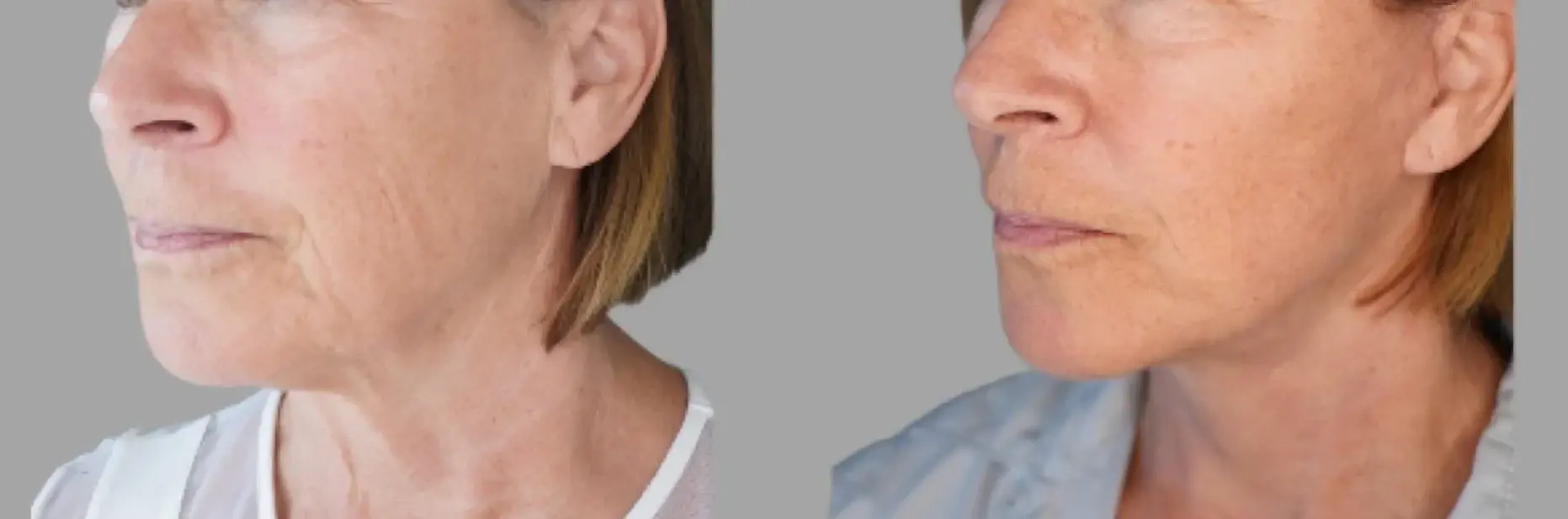 Pavlo Isak, MD facelift result — Newport Beach, CA